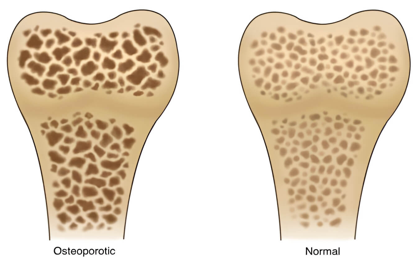 Healthy bone vs. osteoporotic bone Healthy bone vs. osteoporotic bone